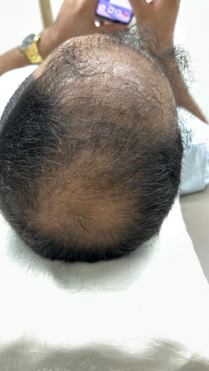 Antes Retomada de densidade